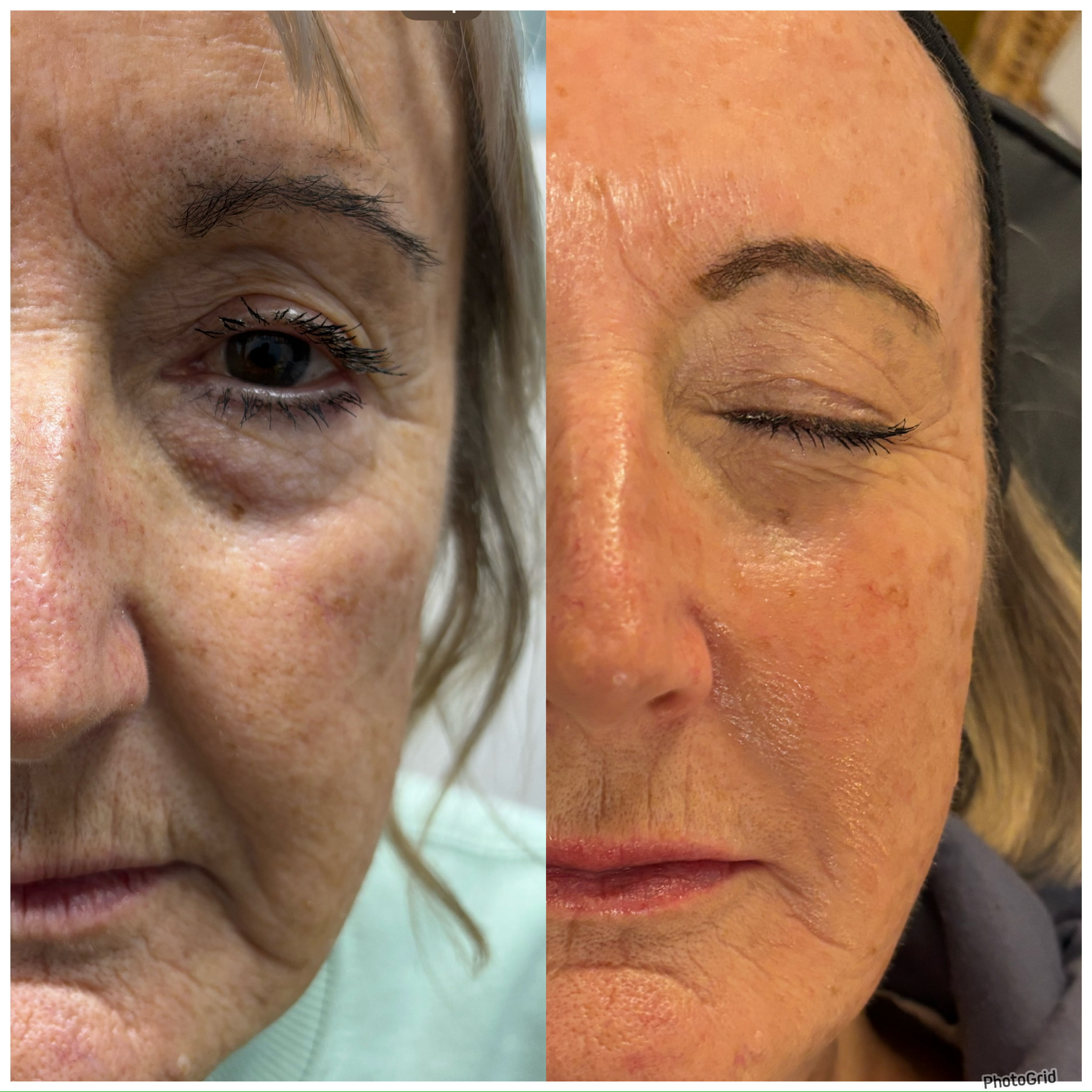 Before and after facial skin rejuvenation showing improved tone and texture