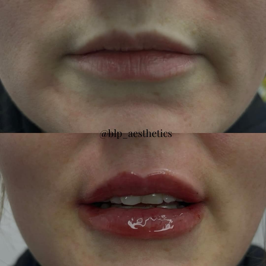 Before and after natural lip filler enhancement by BLP Aesthetics in Bradford
