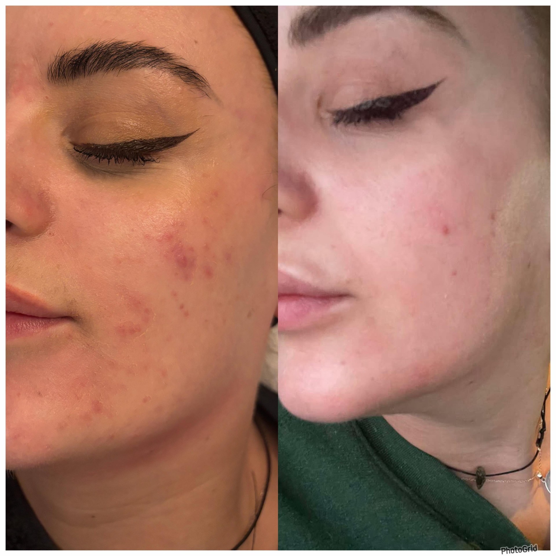 Before and after one chemical peel and two microneedling sessions improving acne and skin texture