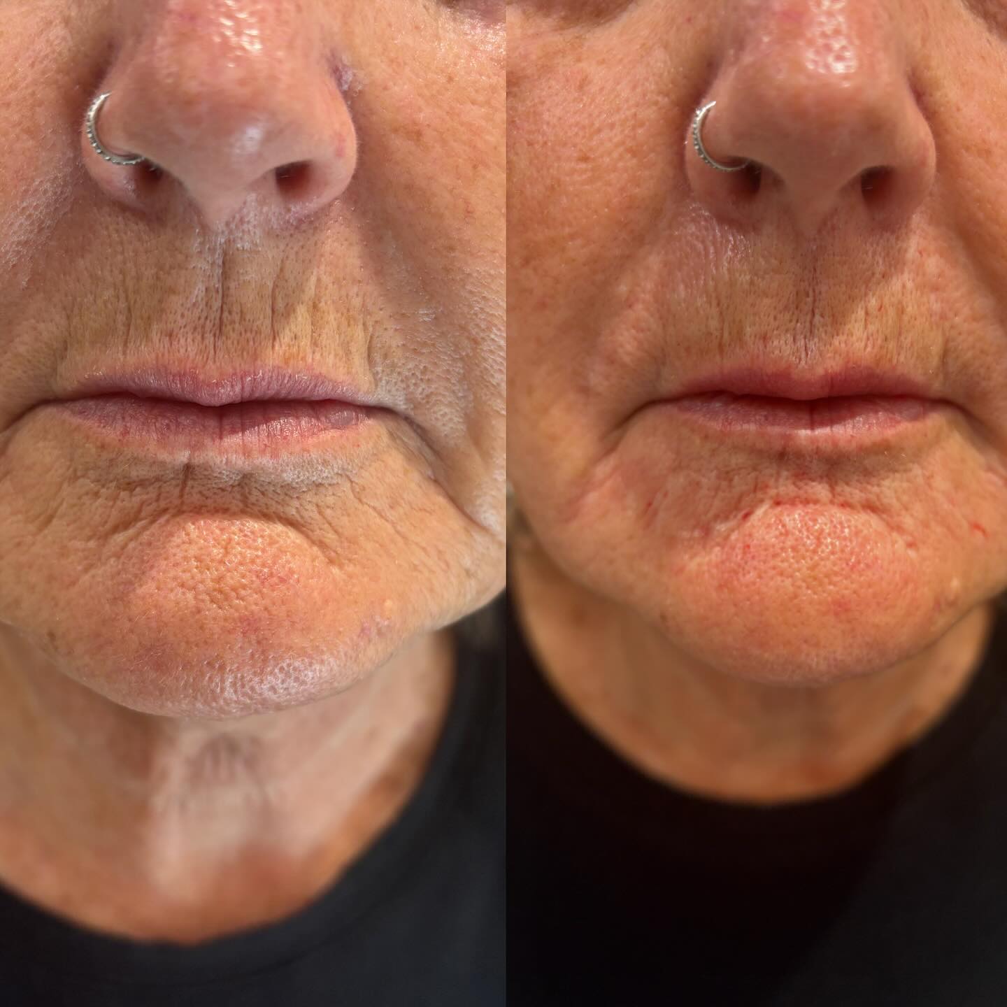 Before and after peri-oral polynucleotide treatment showing smoother skin around the mouth