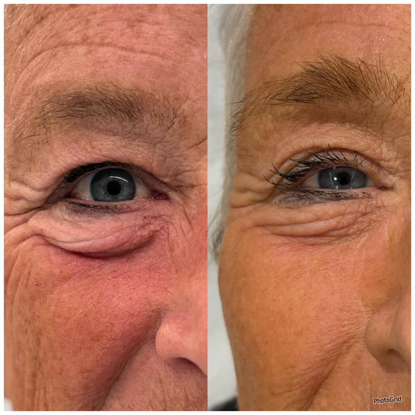 Before and after under-eye Plinest polynucleotides reducing fine lines and crepey skin